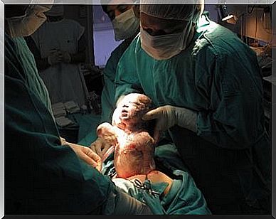 3 things you need to know about a cesarean section