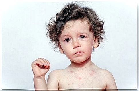 Allergies to Sweat in Children: Symptoms and Treatment