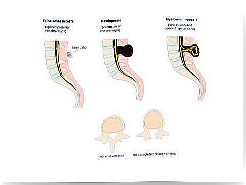 The different forms of spina bifida