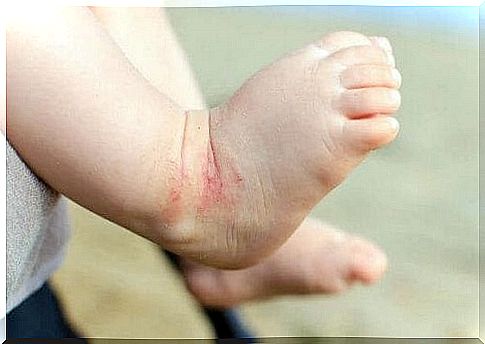 Baby foot with eczema