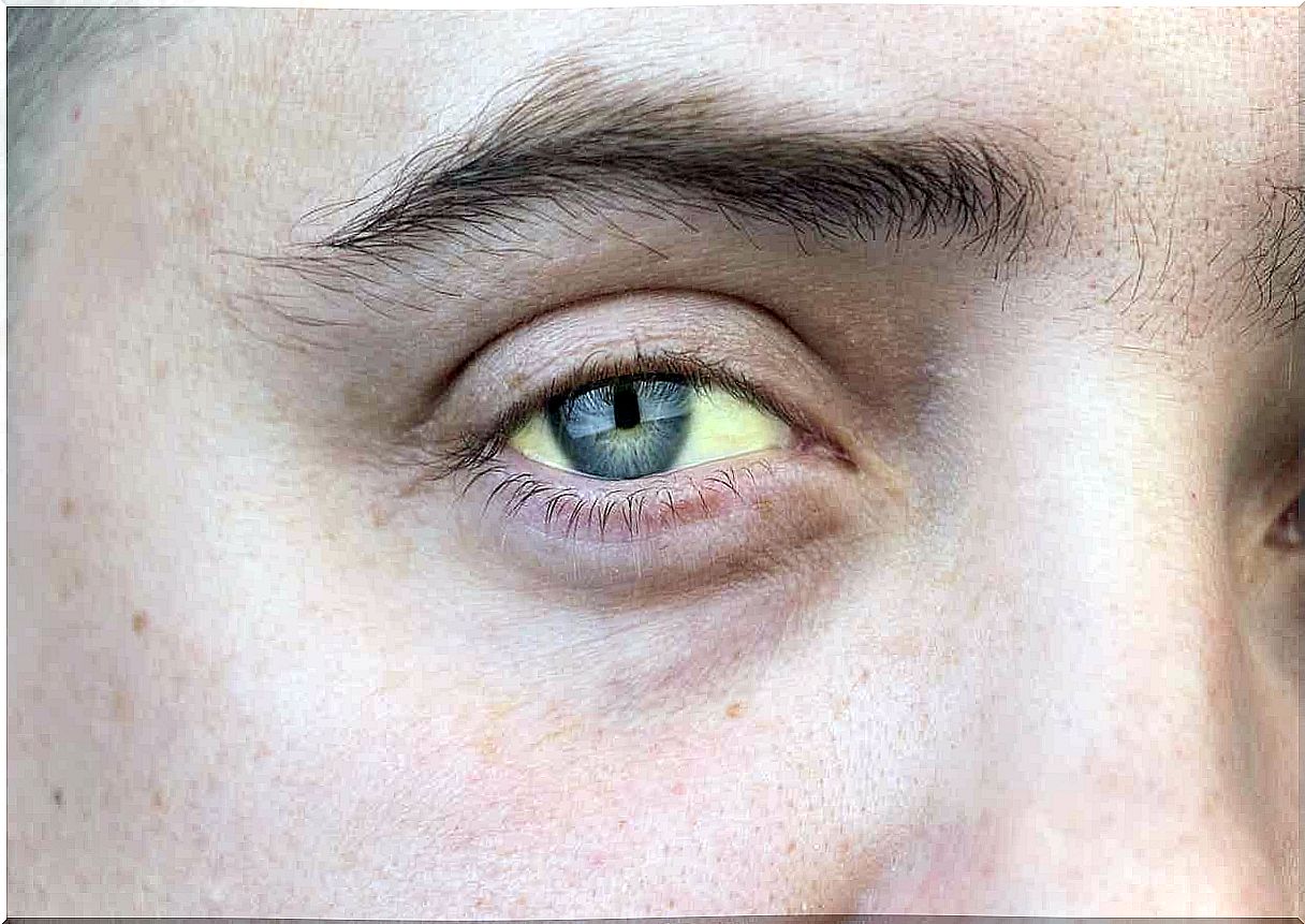 Yellowish eyes may indicate a liver infection