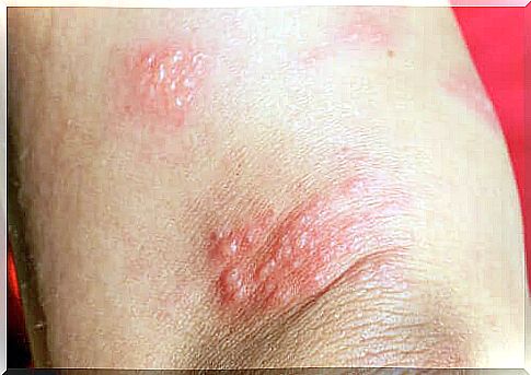 Pregnancy pemphigoid, what is it?