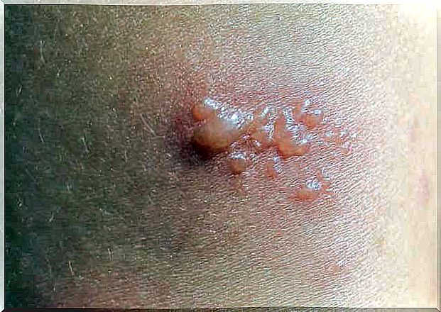 Pregnancy pemphigoid