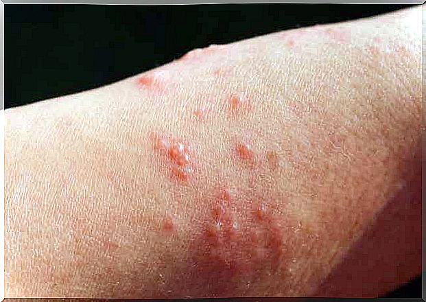 Treating pregnancy pemphigoid